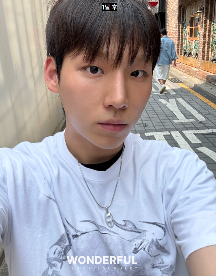 남자 매부리코 성형 변화, 일주일 한달차 붓기 사진 9