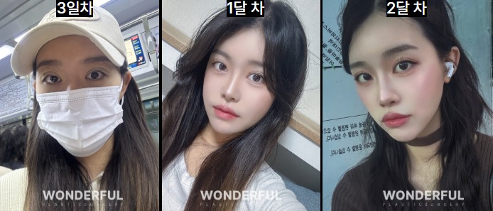 눈수술 후 바다·수영장 언제부터 가능할까요? 여름휴가 전 꼭 확인하세요!