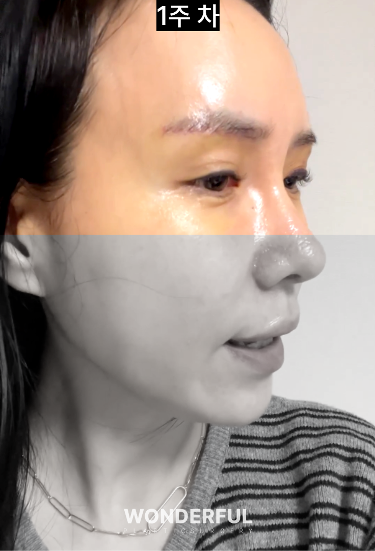 눈썹하거상 흉터, 얼마나 남을까요? 회복 과정 변화 사진 2