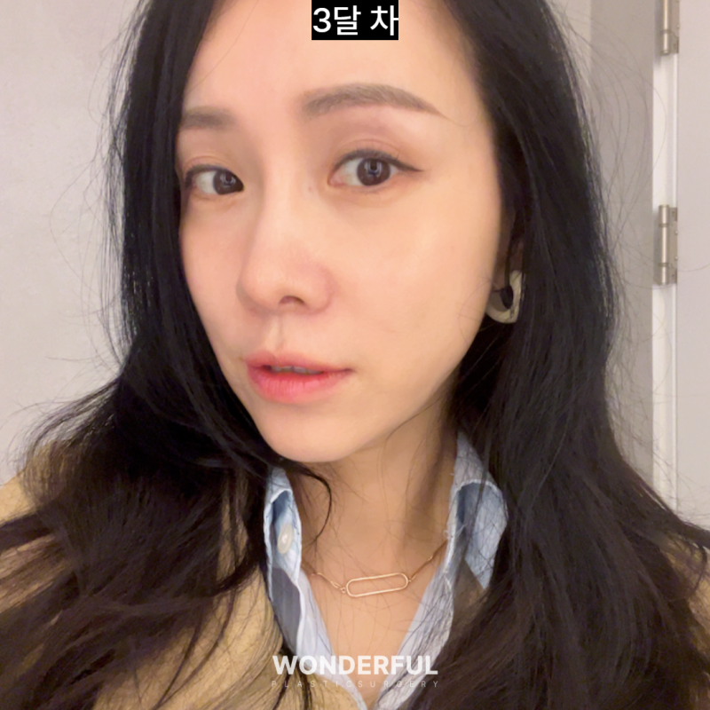 눈썹하거상 흉터, 얼마나 남을까요? 회복 과정 변화 사진 5