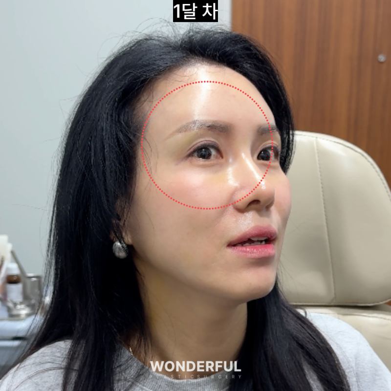 눈썹하거상 흉터, 얼마나 남을까요? 회복 과정 변화 사진 3