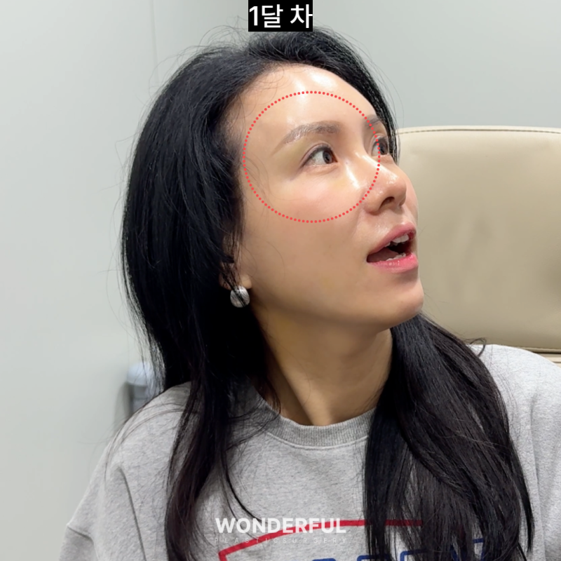 눈썹하거상 흉터, 얼마나 남을까요? 회복 과정 변화 사진 4
