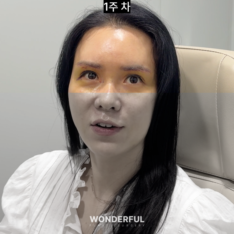 눈썹하거상 흉터, 얼마나 남을까요? 회복 과정 변화