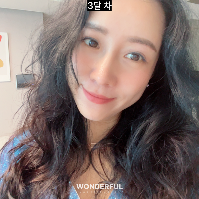 눈썹하거상 흉터, 얼마나 남을까요? 회복 과정 변화 사진 6