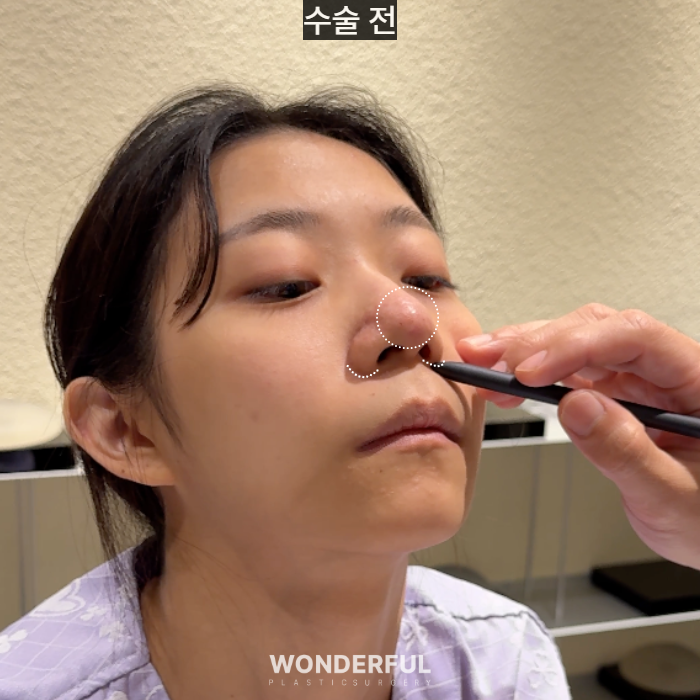 복코수술 후기｜뭉툭한 코, 무보형물 성형 사진 10