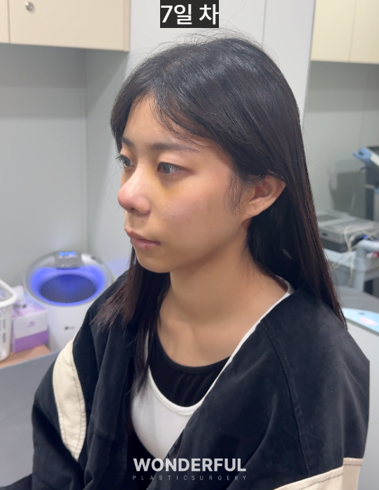 복코수술 후기｜뭉툭한 코, 무보형물 성형 사진 6