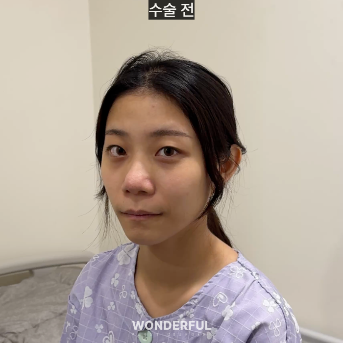 복코수술 후기｜뭉툭한 코, 무보형물 성형 사진 2