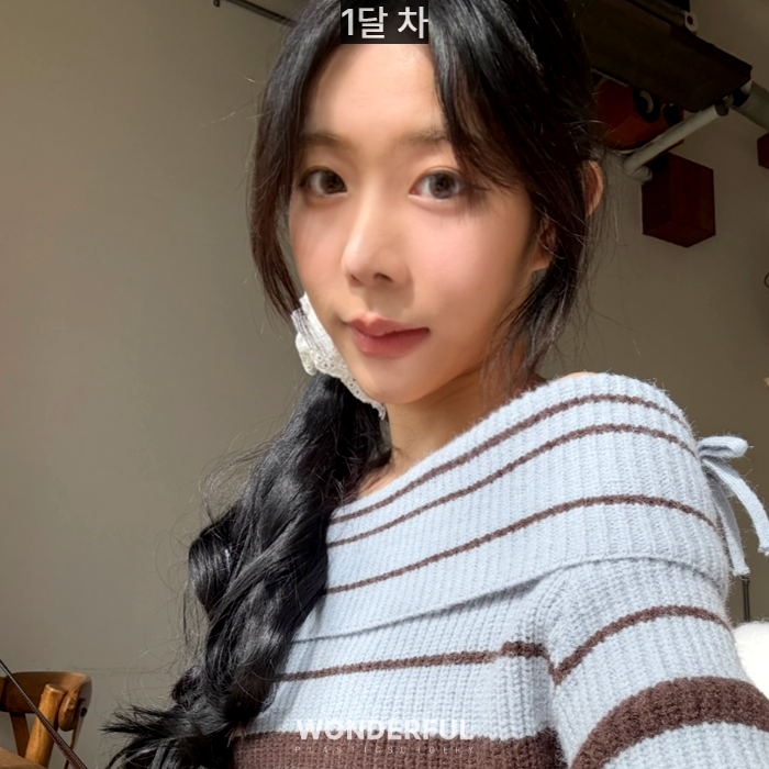 복코수술 후기｜뭉툭한 코, 무보형물 성형 사진 8