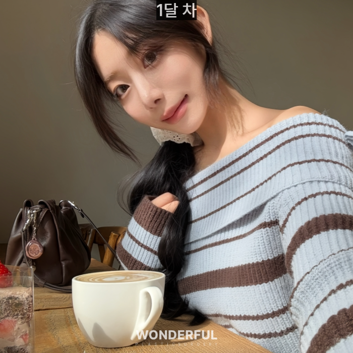 복코수술 후기｜뭉툭한 코, 무보형물 성형 사진 7