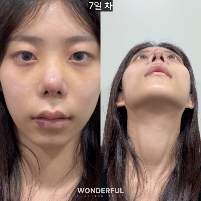 복코수술 후기｜뭉툭한 코, 무보형물 성형 사진 5