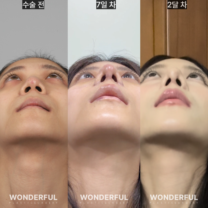 복코수술 후기｜뭉툭한 코, 무보형물 성형 사진 9