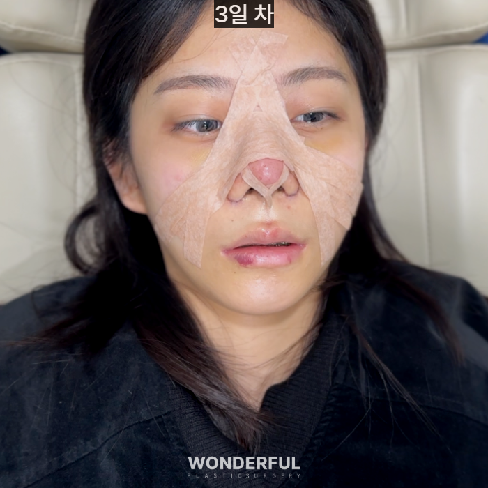 복코수술 후기｜뭉툭한 코, 무보형물 성형 사진 3