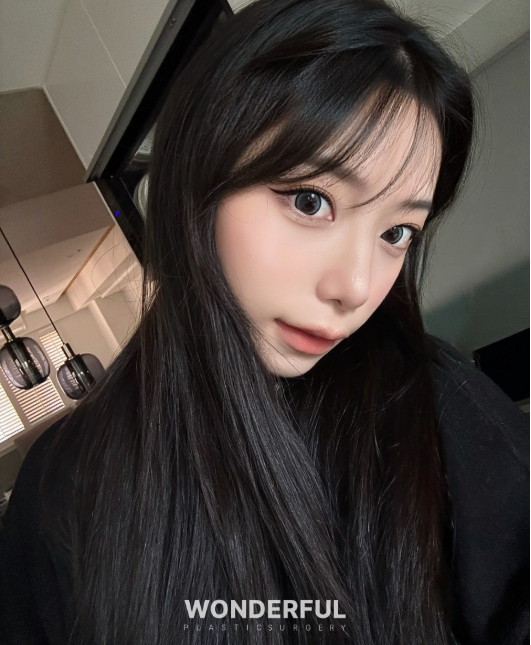 복코수술 후기｜뭉툭한 코, 무보형물 성형 사진 11