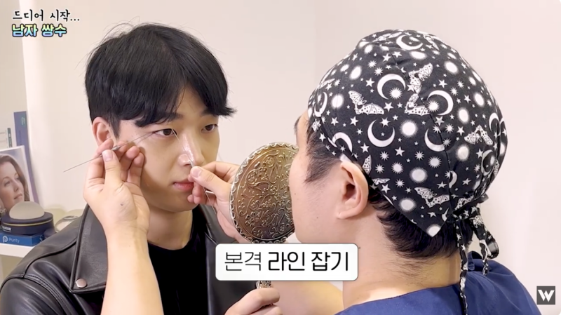 남자 무쌍성형 수술 당일부터 한달 변화 사진 3