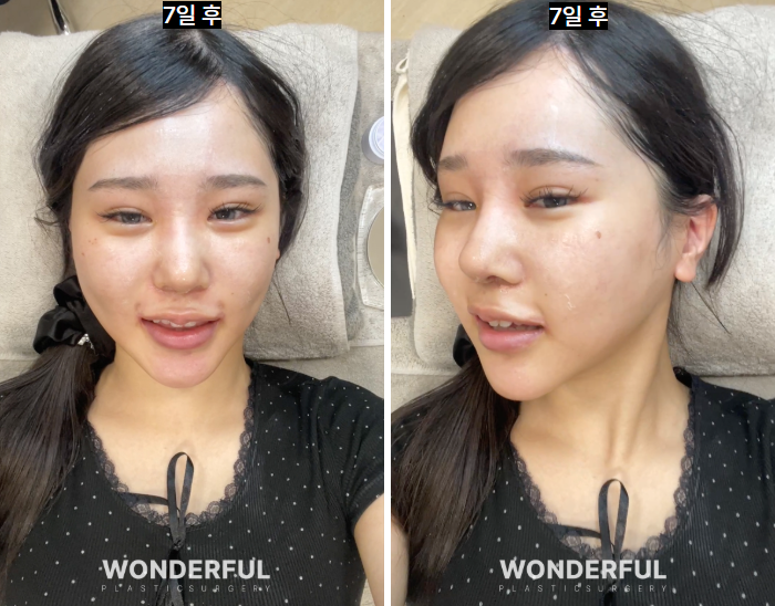 성형수술 상담, 이것만은 꼭 물어보세요! 꼭 해야 하는 질문 5가지 사진 6
