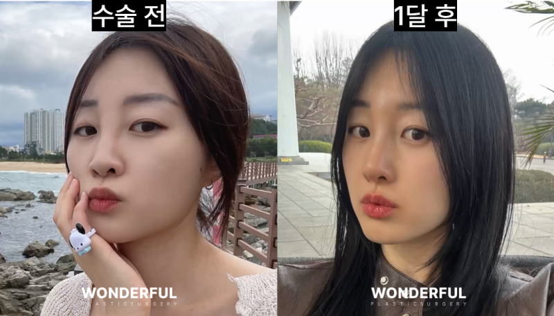 콧대 필러를 맞았는데 코수술이 가능할까요? 사진 3