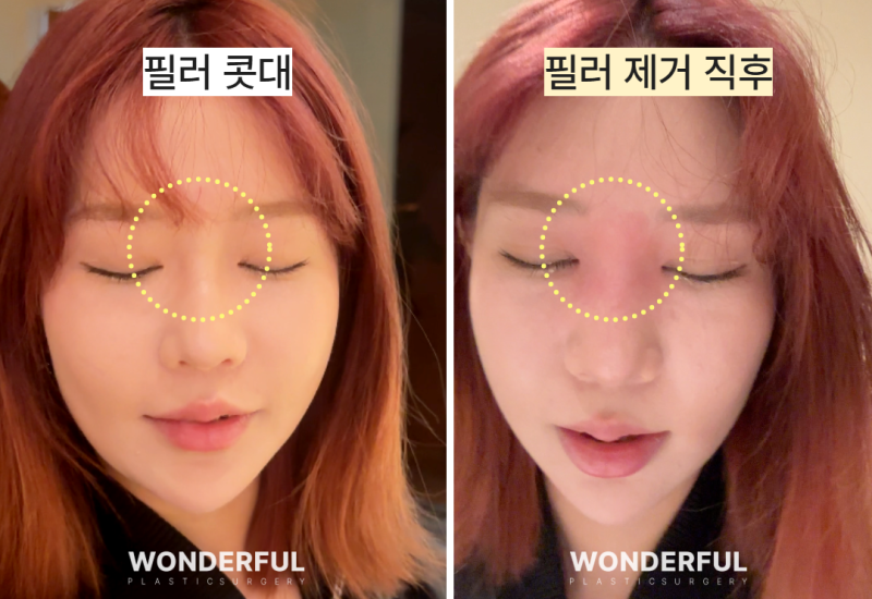 콧대 필러를 맞았는데 코수술이 가능할까요? 사진 2