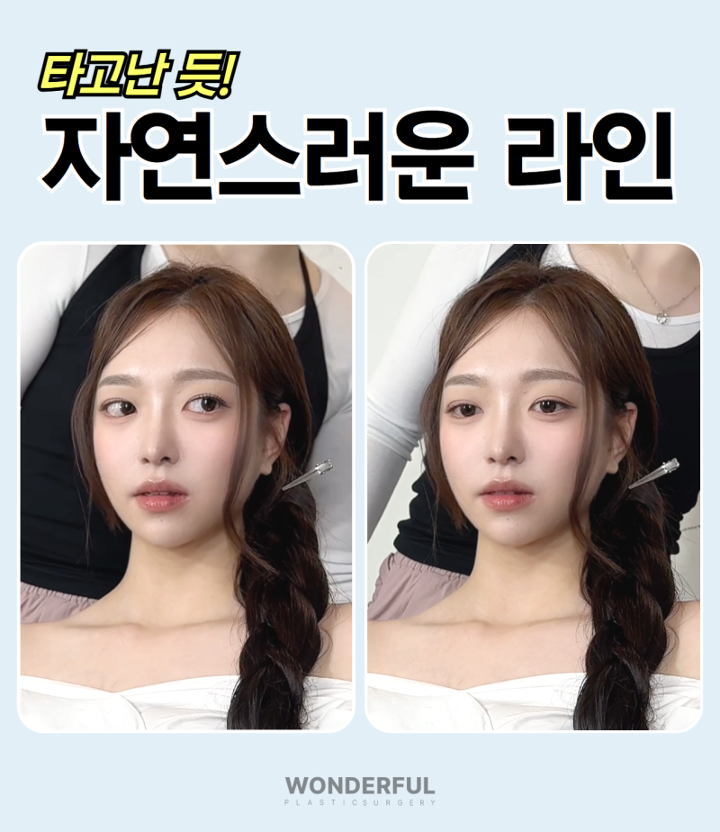 (7월 한정) 원더풀 성형외과 눈성형 추가금 없는 쌍수 가격 이벤트 사진 4