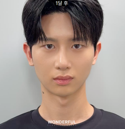 "쌍꺼풀 수술상담에서 원장님이 가장 많이 받는 질문 TOP5" 사진 7