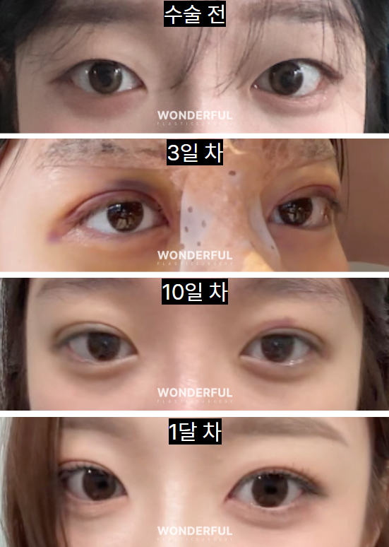 "쌍꺼풀 수술상담에서 원장님이 가장 많이 받는 질문 TOP5" 사진 5