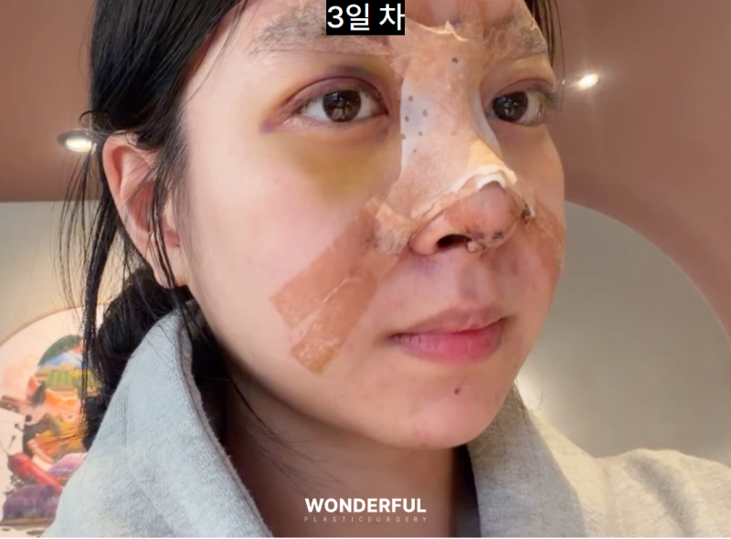 쌍수붓기 빨리 빼는법! 사진 8