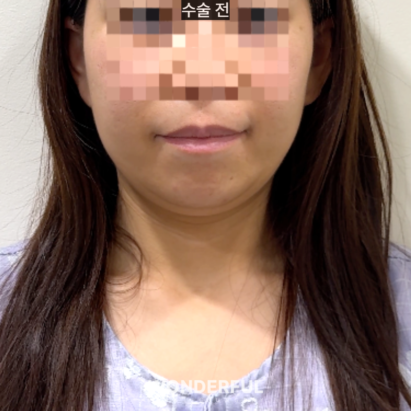 กังวลเรื่องเหนียงใต้คาง? ดูดไขมันเหนียง! ผลลัพธ์และระยะเวลาพักฟื้น
