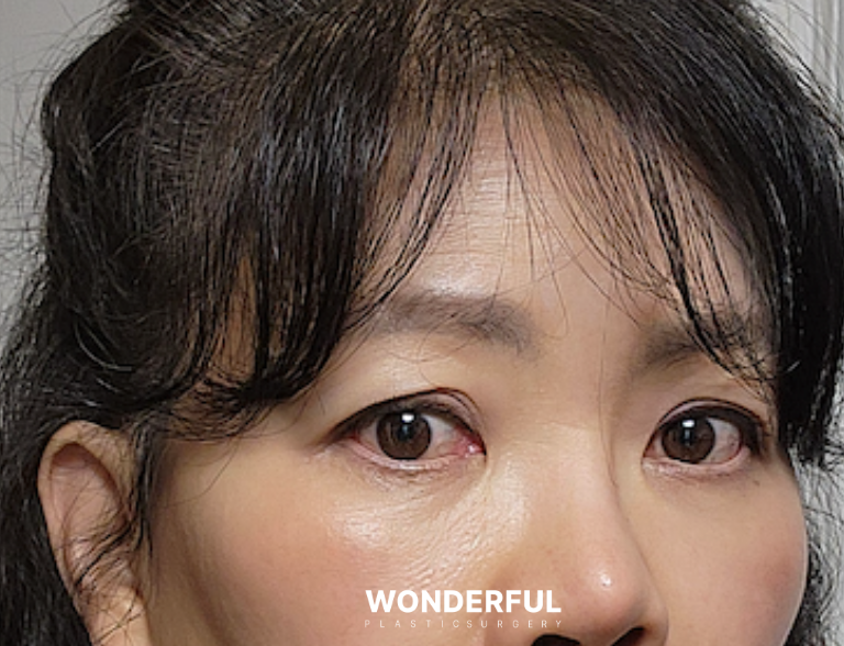 กรณีที่จำเป็นต้องผ่าตัดยกกระชับใต้คิ้ว (Subbrow Lift)! ลองเช็กด้วยตัวเองดูสิคะ