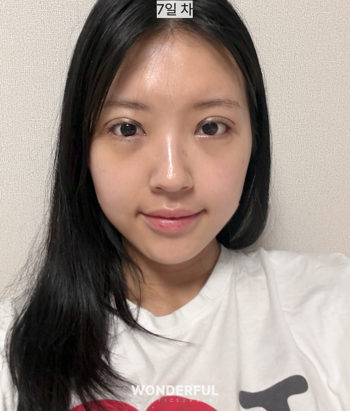 뒤밑트임 한달 후기 사진 4
