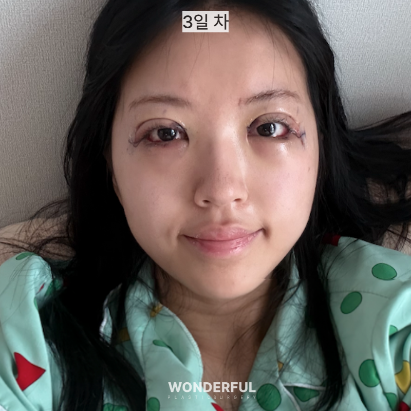뒤밑트임 한달 후기 사진 3
