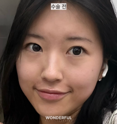 뒤밑트임 한달 후기 사진 5