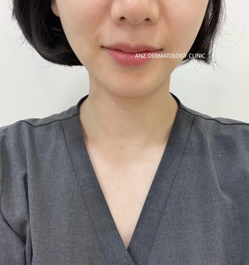 티타늄리프팅의 모든 것 (원리, 샷수, 효과, 장단점) 사진 8