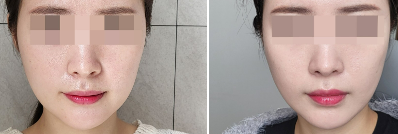 티타늄레이저 에너지(KJ)에 대해 사진 4