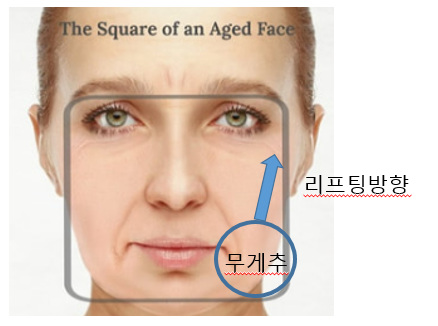 매년받는 울쎄라 샷수 줄이는 비법 사진 3