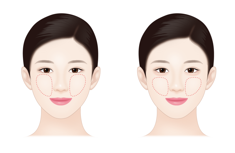 애교살의 장점 (애교살 운동하세요!) 사진 6