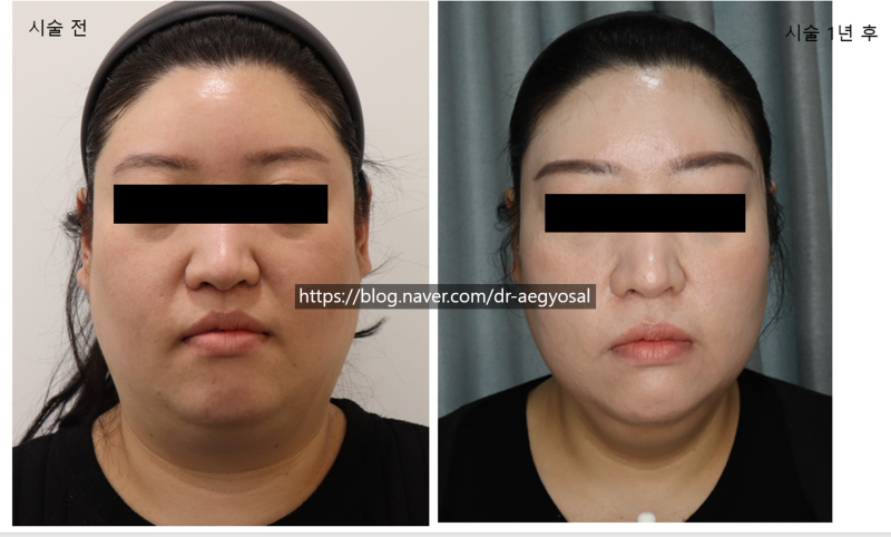 초음파윤곽술 후기/超音波輪廓术 评论/ultrasoniclipolysis review 사진 8