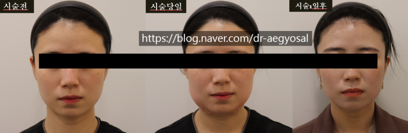초음파윤곽술 후기/超音波輪廓术 评论/ultrasoniclipolysis review