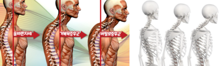 버섯목증후군/버팔로험프/뒷목굳은살 의 모든 것 (수술적 치료) 사진 6