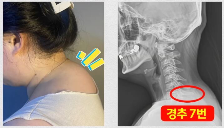 버섯목증후군/버팔로험프/뒷목굳은살 의 모든 것 (수술적 치료) 사진 5