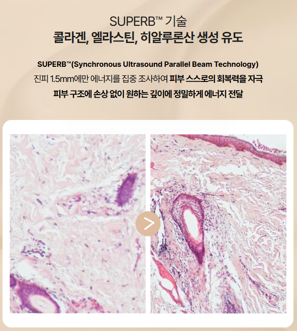 리프팅의 본질 ② 소프웨이브편 사진 6