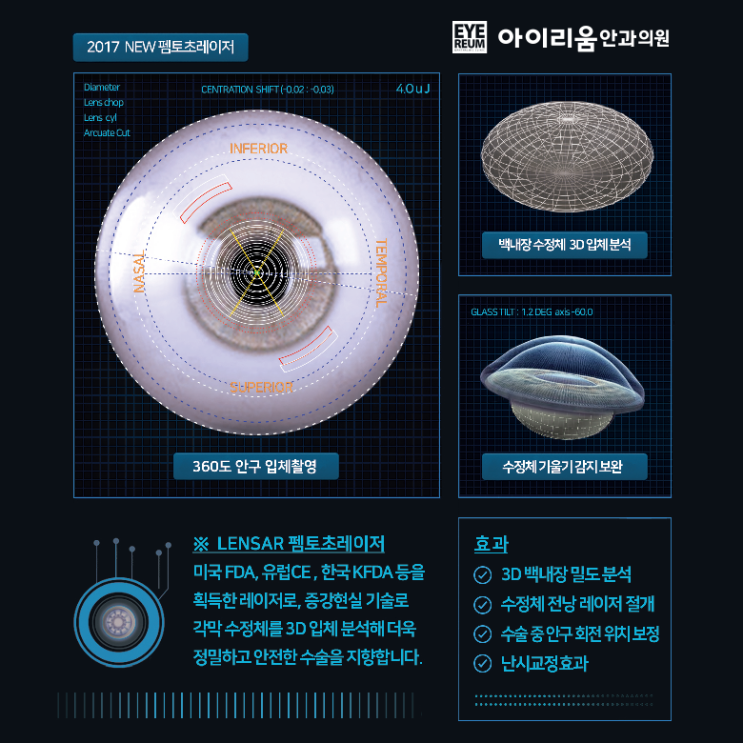 [백내장궁금증]백내장 증상과 치료법은?