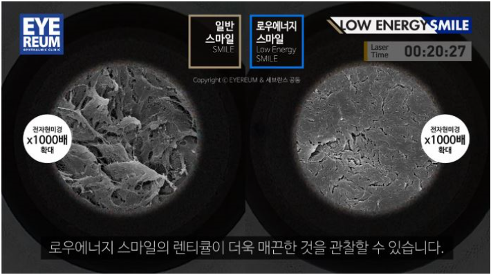 스마일라식가격 보다 중요한 것