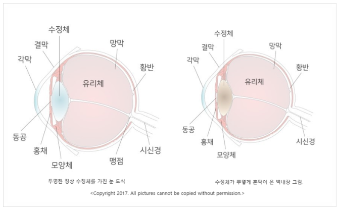 레이저장비를 이용한 백내장 수술, 맞춤형 수술로 안전성 향상