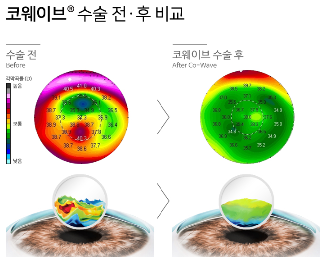 [아이리움안과] 라섹빛번짐, 어떻게 개선하였는가?