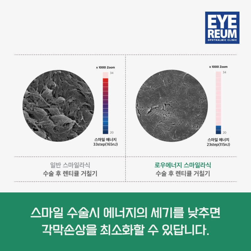 라식수술추천! 로우에너지 스마일 라식이여야하는 이유 ★