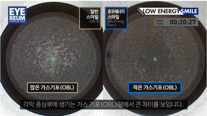 군인라식라섹으로 유명한 ‘로우에너지스마일’