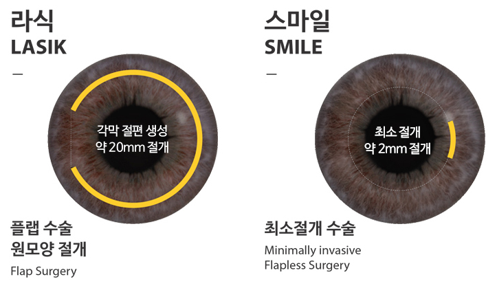 만족도 높은 스마일라식후기를 보면 ‘로우에너지 스마일’