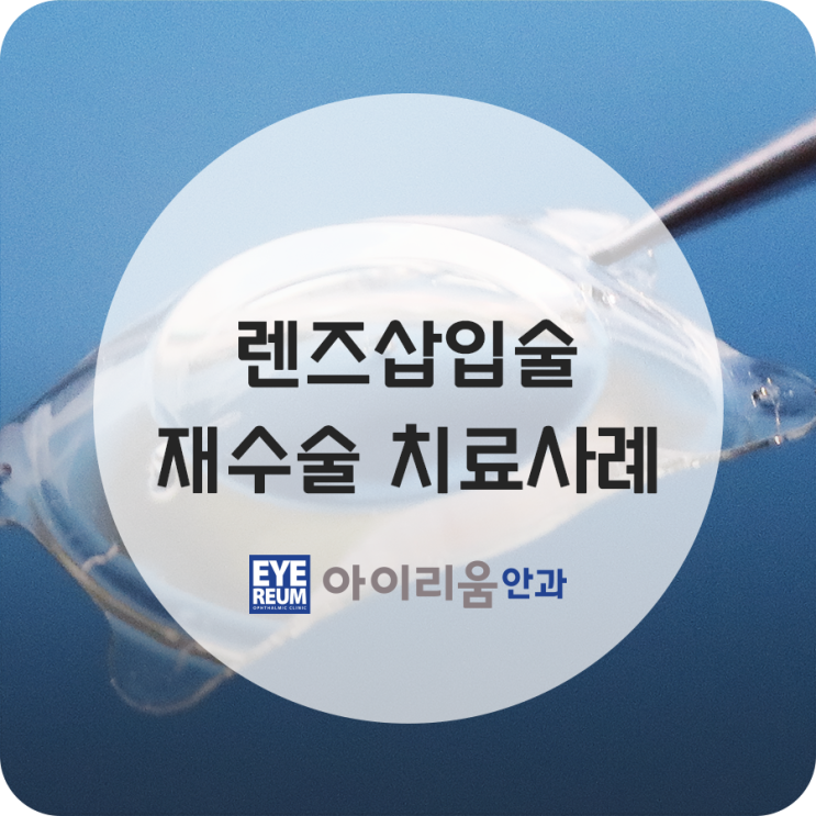 [렌즈삽입술 재수술잘하는병원] 렌즈삽입 재수술 치료사례