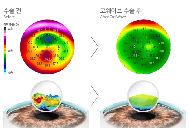 아이리움안과 라섹수술은 각막 맞춤형 코웨이브라섹