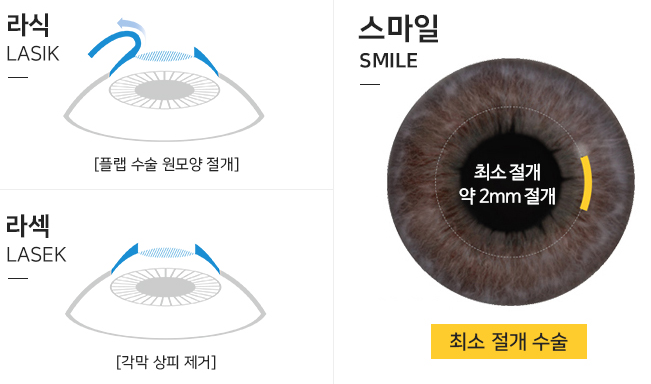스마일라식 후 화장, 운동은 언제부터? 주의사항에 대해 알아보자!