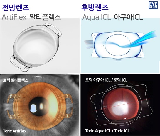 렌즈삽입술 비용, 난시교정효과, 수술 전 주의사항